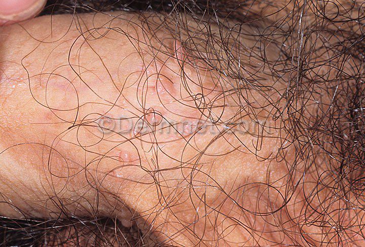 What Does Hpv Look Like On A Man