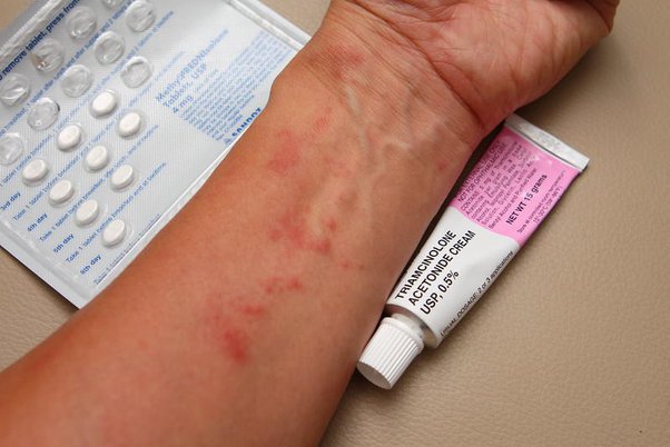 What Is Triamcinolone Cream 0.1 Used To Treat