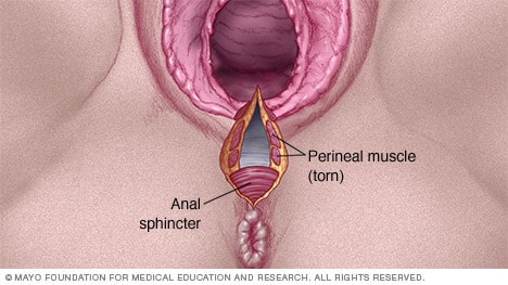 What Does A Vaginal Tear Look Like
